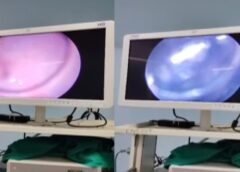 Ambedkar Nagar doctors, Ambedkar Nagar latest news updates, A toothbrush stuck in a child's throat, Ambedkar Nagar Medical College, Doctors removed a toothbrush stuck in the throat,